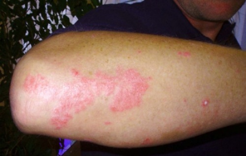 El tratamiento de la psoriasis en ekaterinburge